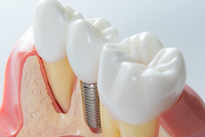 Zahnimplantaten in Rosengarten Weiss Dental